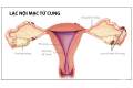 Những điều quan trọng về bệnh u lạc nội mạc tử cung