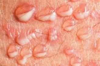 Bệnh mụn rộp sinh dục có ngứa không