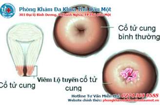 Triệu chứng viêm lộ tuyến cổ tử cung độ 3