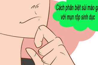 Cách phân biệt sùi mào gà với mụn rộp sinh dục