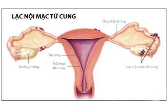 Những điều quan trọng về bệnh u lạc nội mạc tử cung