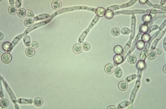 Bị ngứa lông mu vùng kín nữ: Nguyên nhân và cách trị