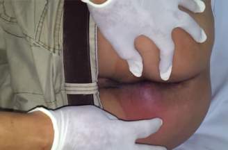 Nguyên nhân gây apxe hậu môn chủ yếu