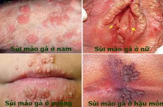 Nguyên nhân gây bệnh sùi mào gà? Bình Dương