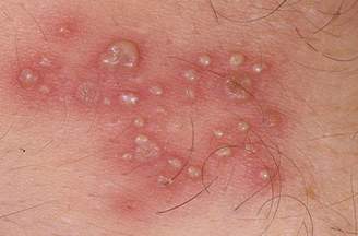 Nổi hạt trắng ở vùng kín có bị sùi mào gà?