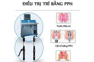 Phương pháp cắt trĩ PPH hiện đại