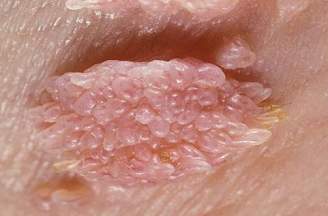 Sùi mào gà bị chảy máu có sao không