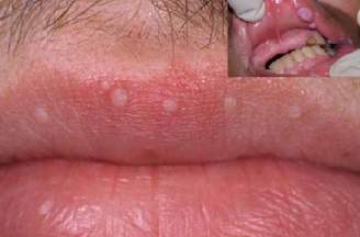 Sùi mào gà giai đoạn đầu có dấu hiệu gì?