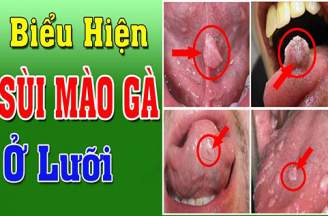 Bệnh sùi mào gà ở lưỡi - Biểu hiện và cách chữa trị hiệu quả