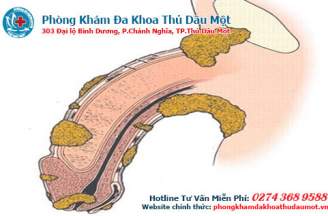 Viêm bao quy đầu tồn tại những nguy hại nào?