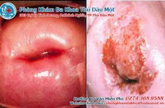 Chị em đốt viêm lộ tuyến có đẻ thường được không?